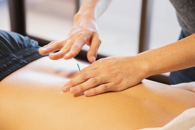 A person receiving a private acupuncture treatment