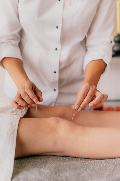 A person receiving a relaxing acupuncture treatment