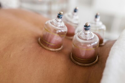 A person receiving a cupping treatment