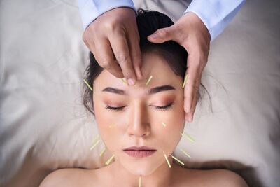 A woman with glowing skin receiving cosmetic facial acupuncture