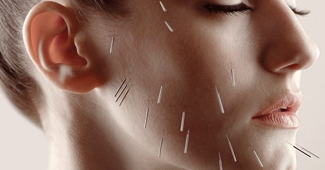Everything You Need to Know About Cosmetic Acupuncture and Micro-Needling [Infographic] image