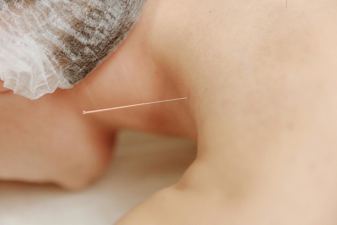 A person receiving an acupuncture treatment