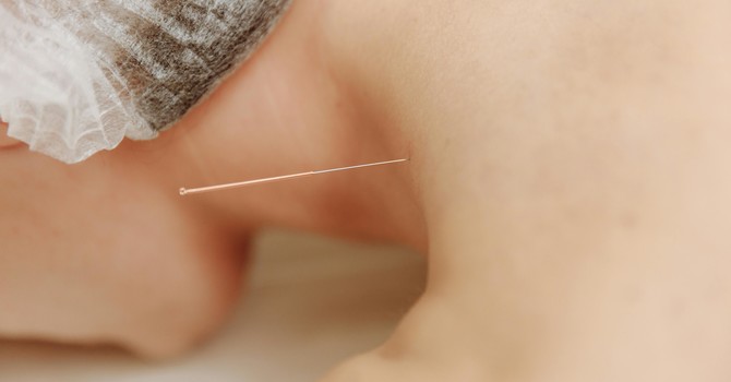 7 Fun Facts About Acupuncture [Infographic] image