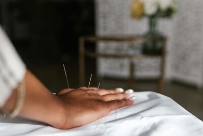 Acupuncture needles in the hand of a fully clothed woman