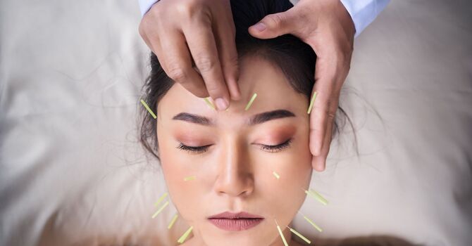 Cosmetic Acupuncture/Microneedling