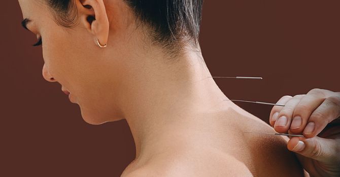 Fertility Acupuncture