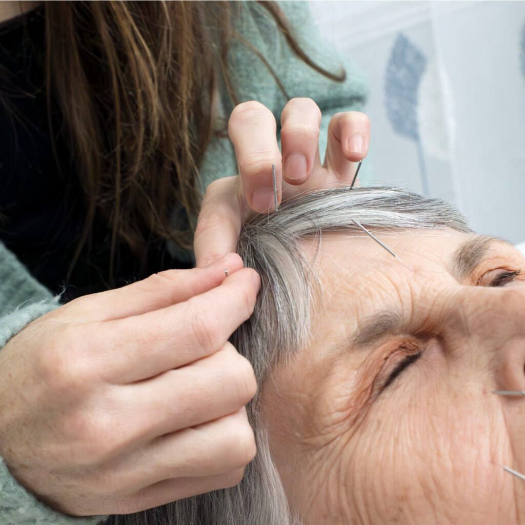 A woman getting cosmetic facial acupuncture to help reduce aging.