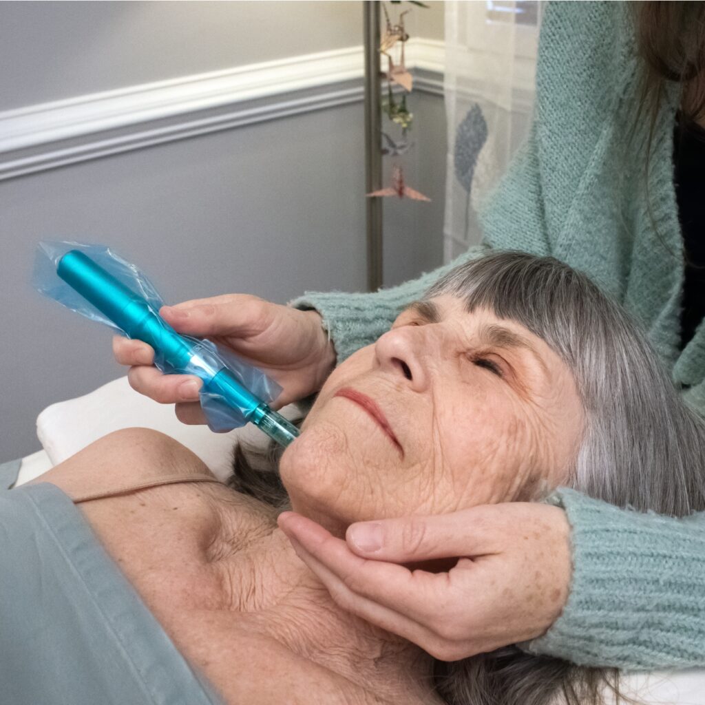 A woman getting micro-needling to help tighten skin and reduce wrinkles.